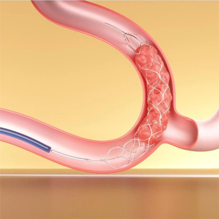 Retrievable Stent For Stroke