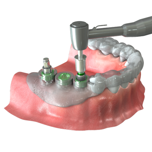 Digitized implant treatment solution 