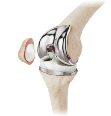 Arthroplasty Comprehensive Solutions
