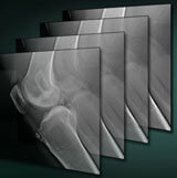 Digital Tomosynthesis